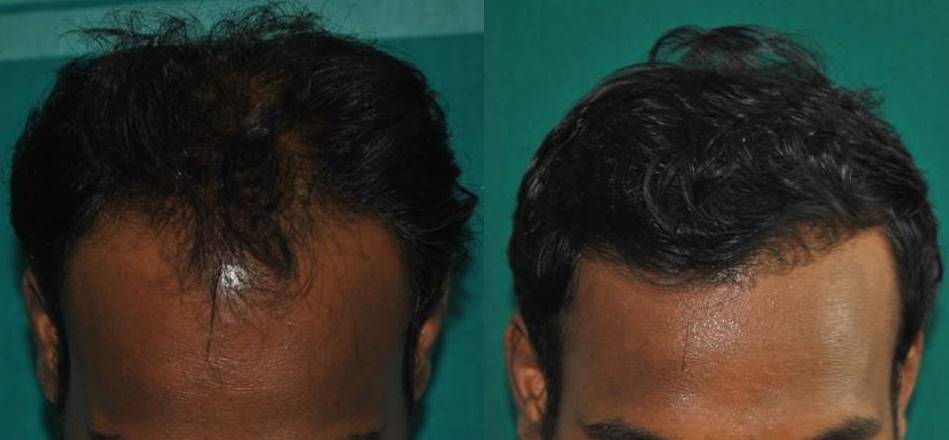 Baldness cure Ernakulam, Kerala